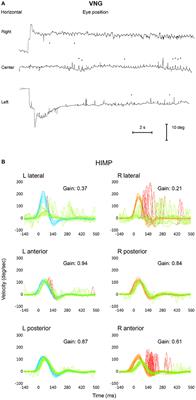 Vestibular Function Measured Using the Video Head Impulse Test in Congenital Nystagmus and Vertigo: A Case Report